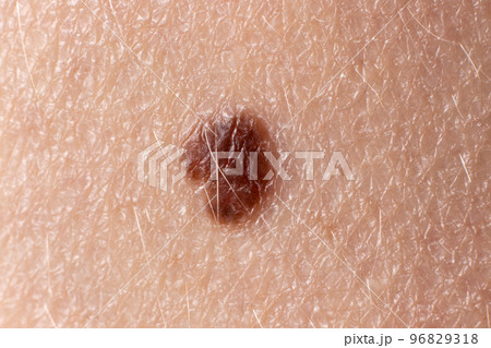Mole birthmark nevus macro photo on human skin. Close up. Mole birthmark nevus macro photo on human skin. Close up. 96829318