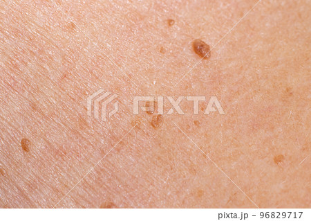 Papilloma on human skin - benign tumor in the form of mole, nevus Papillomatosis medicine Papilloma on human skin - benign tumor in the form of mole, nevus Papillomatosis medicine 96829717