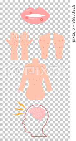 Syphilis symptom set 96833918