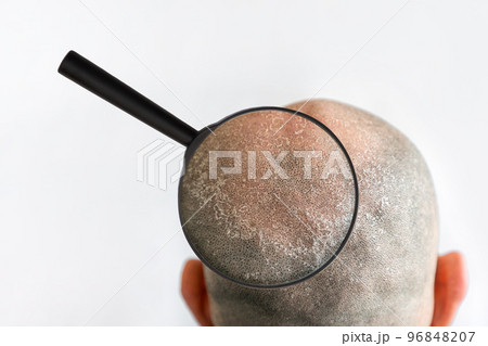 Man's bald flaky head with dandruff and zoomed with magnifier problem area, back view. White background. The concept of psoriasis, sunburn and seborrheic dermatitis 96848207