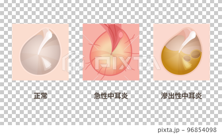 Illustration of eardrum of otitis media _ normal _ acute otitis media _ otitis media with effusion Illustration of eardrum of otitis media _ normal _ acute otitis media _ otitis media with effusion 96854098
