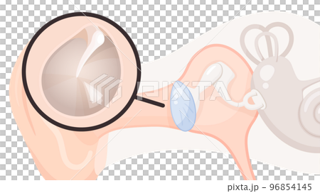 耳朵結構與耳膜示意圖_正常耳膜 耳朵結構與耳膜示意圖_正常耳膜 96854145