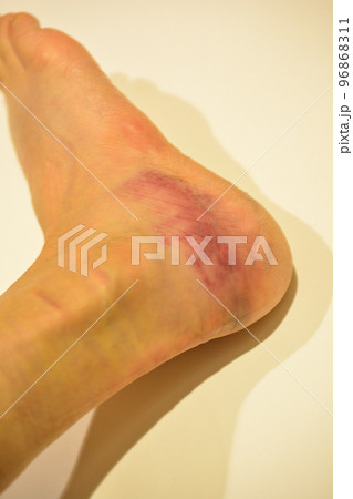 捻挫で赤く腫れた足首 96868311
