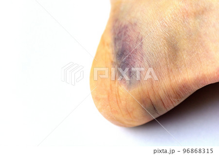 捻挫で赤く腫れた足首 捻挫で赤く腫れた足首 96868315