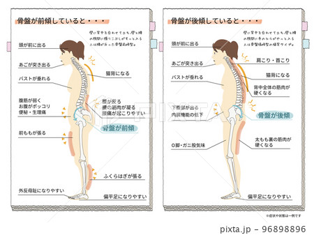 人物の骨盤が後傾・前傾したときにおこる症状と状態を表した横向きのイラスト 96898896