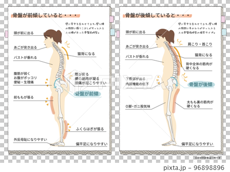 人物の骨盤が後傾・前傾したときにおこる症状と状態を表した横向きのイラスト 96898896