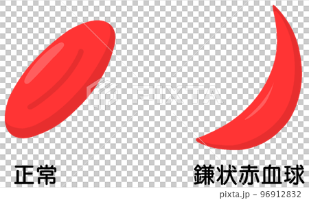 鎌状赤血球症は目にどのような影響を及ぼしますか?