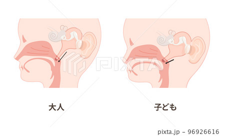 大人と子どもの耳管のイラスト_矢状断 大人と子どもの耳管のイラスト_矢状断 96926616