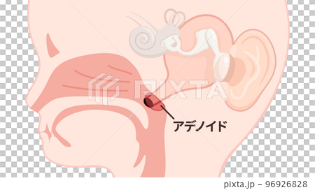 Illustration of a child's eustachian tube and enlarged adenoids_sagittal section_with letters Illustration of a child's eustachian tube and enlarged adenoids_sagittal section_with letters 96926828