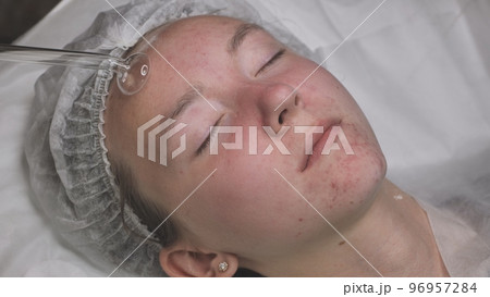 A beautician makes a darsonvalization of the face of a young girl with problem skin. 96957284