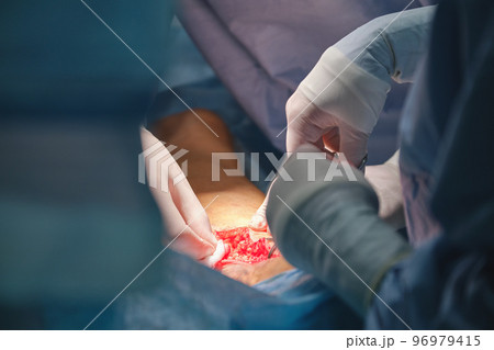 Closeup of doctors hands operating a patient conducting open cut surgery in surgical room. Healthcare and medical intervention concept Closeup of doctors hands operating a patient conducting open cut surgery in surgical room. Healthcare and medical intervention concept 96979415