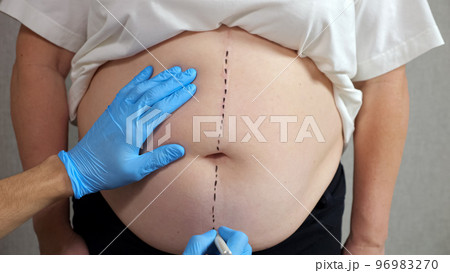 Hand of specialist makes marks on belly of curvy woman Hand of specialist makes marks on belly of curvy woman 96983270
