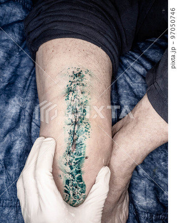 Endoprosthesis of the knee joint. Medic check male leg Endoprosthesis of the knee joint. Medic check male leg 97050746
