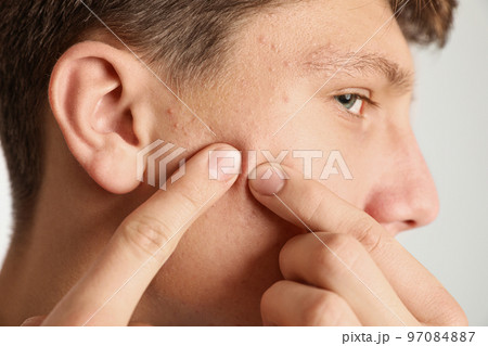 Teen guy with acne problem squeezing pimple on his face on light background, closeup Teen guy with acne problem squeezing pimple on his face on light background, closeup 97084887