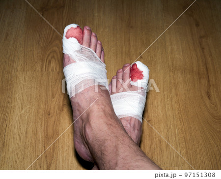 A blood bandaged big toe 97151308