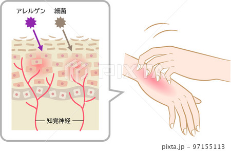 アトピー性皮膚炎 肌細胞 手を掻く アトピー性皮膚炎 肌細胞 手を掻く 97155113