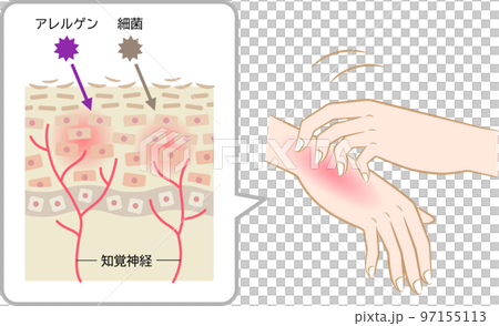 特應性皮炎皮膚細胞抓手 特應性皮炎皮膚細胞抓手 97155113