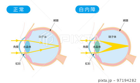 正常な目と白内障の目の断面 97194282