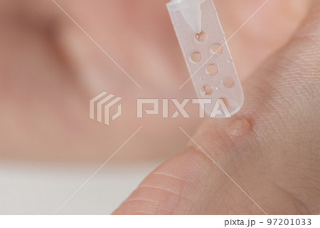 Wart treatment process. The doctor applies the medicine with a special spatula to the wart. Getting rid of a benign formation on human skin by using a medicine. 97201033