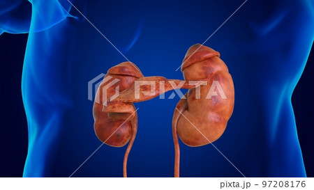 human damaged kidney anatomy for medical concept 3D 97208176
