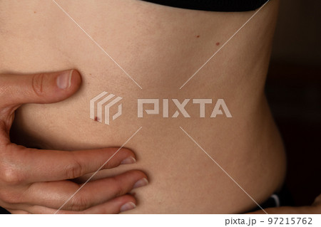 Unrecognizable woman showing her Birthmarks on skin Close up detail of the bare skin Sun Exposure effect on skin, Health Effects of UV Radiation Woman with birthmarks Pigmentation Unrecognizable woman showing her Birthmarks on skin Close up detail of the bare skin Sun Exposure effect on skin, Health Effects of UV Radiation Woman with birthmarks Pigmentation 97215762