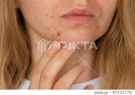 Unrecognizable woman showing her acne on face. Close-up acne on woman's face with rash skin ,scar and spot that allergic to cosmetics. Problem skincare and health concept. Wrinkles, melasma, dark Unrecognizable woman showing her acne on face. Close-up acne on woman's face with rash skin ,scar and spot that allergic to cosmetics. Problem skincare and health concept. Wrinkles, melasma, dark 97215778