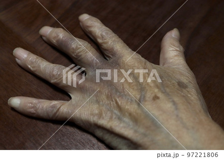 打撲して内出血した80代女性の手の甲 97221806