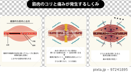 Illustration of the mechanism that blood flow and stiffness in healthy muscles cause pain due to poor blood flow 97241895