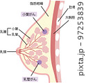 乳がんのイラスト 97253839