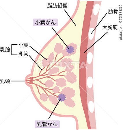 乳がんのイラスト 97253839