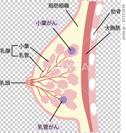 乳がんのイラスト 97253839