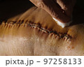 Surgical suture on the knee. Surgical wound sutured with special metal suture for healing. Total knee joint replacement. Close-up. 97258133