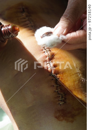 Surgical suture on the knee. Surgical wound sutured with special metal suture for healing. Total knee joint replacement. Close-up. 97258140