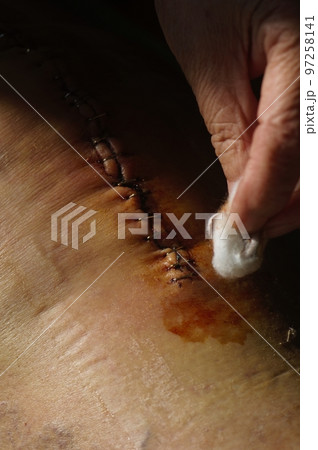 Surgical suture on the knee. Surgical wound sutured with special metal suture for healing. Total knee joint replacement. Close-up. Surgical suture on the knee. Surgical wound sutured with special metal suture for healing. Total knee joint replacement. Close-up. 97258141