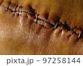 Surgical suture on the knee. Surgical wound sutured with special metal suture for healing. Total knee joint replacement. Close-up. 97258144