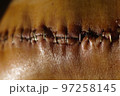 Surgical suture on the knee. Surgical wound sutured with special metal suture for healing. Total knee joint replacement. Close-up. 97258145