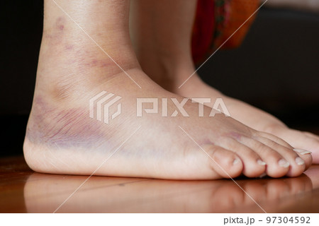 close up of women feet with swelling  97304592