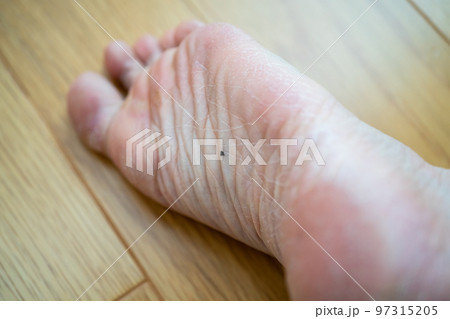 足の裏のホクロ 97315205