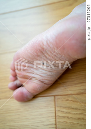 足の裏のホクロ 足の裏のホクロ 97315206