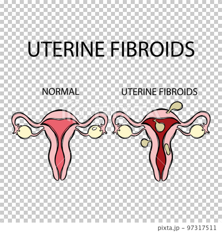 UTERINE FIBROIDS VS NORMAL Leiomyoma Benign...のイラスト素材 [97317511] - PIXTA