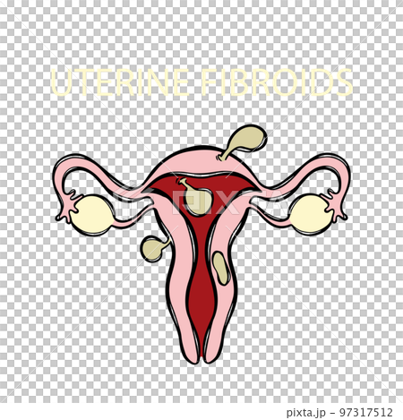 UTERINE FIBROIDS Leiomyoma Benign Tumor Of The Smooth Muscles Of The Uterus Painful Or Severe Menstruation Medical Education Banner Vector Illustration Scheme 97317512
