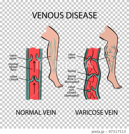 VARICOSE VEINS Venous Disease Of Human Legs Twisting And Dilation Of Blood Vessels Schematic Representation Of Changes In Body Parts For Medical Education 97317513