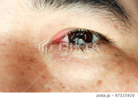 Closeup Swollen eyes or Blepharitis eyes of asian man. Medicine and healthcare concept. 97325920