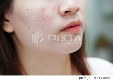 Acne pimple and scar on skin face, disorders of sebaceous glands, teenage girl skincare beauty problem. Acne pimple and scar on skin face, disorders of sebaceous glands, teenage girl skincare beauty problem. 97354069