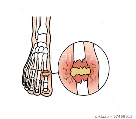 痛風 痛風 97469919