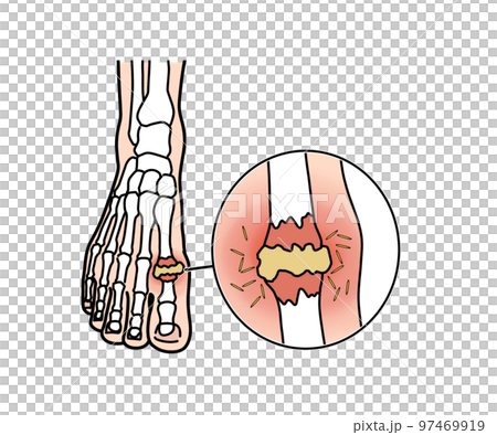 痛風 痛風 97469919