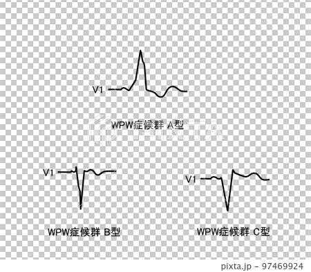 WPW症候群の心電図 WPW症候群の心電図 97469924