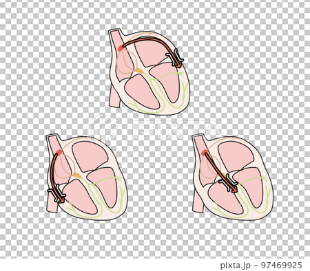 WPW症候群(A/B/C) WPW症候群(A/B/C) 97469925