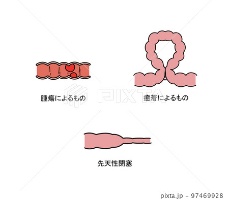 単純性イレウス 97469928