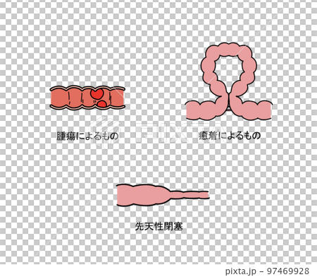 単純性イレウス 97469928